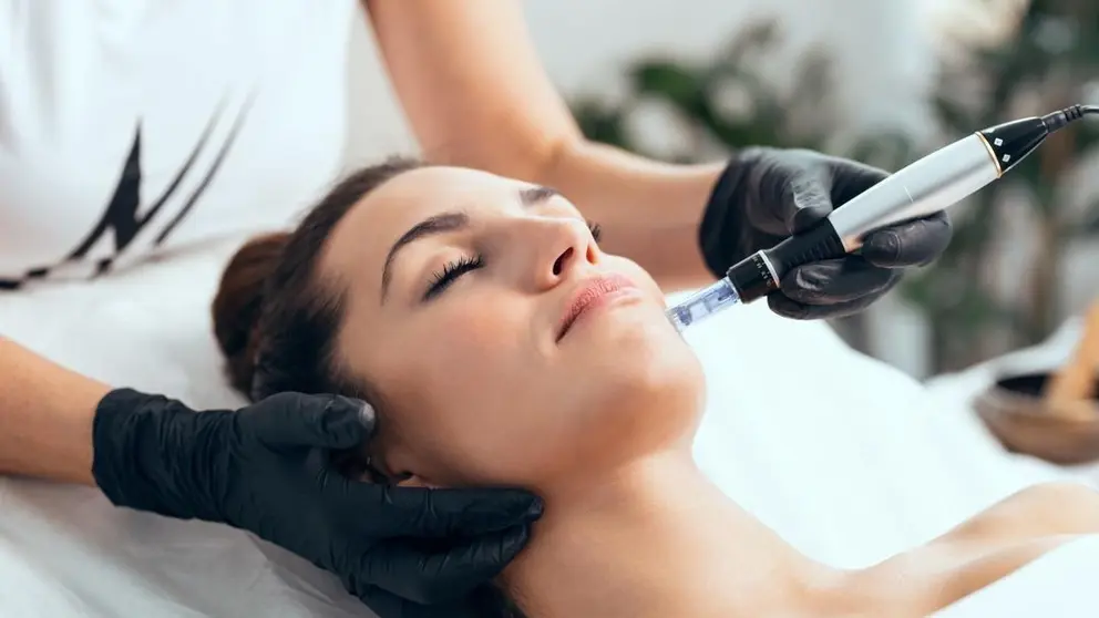 Microneedling facial.
Foto de: Knott Street Dermatology